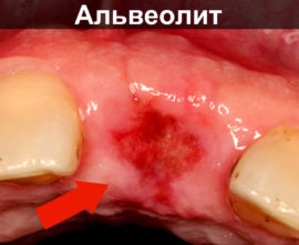 Alveolitis jamky