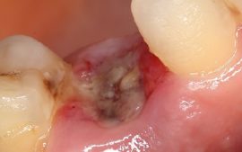 Alvéolite après extraction dentaire