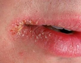 Angular stomatitis