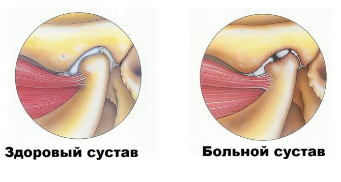 Artritida temporomandibulárního kloubu