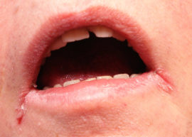 Atopic cheilitis