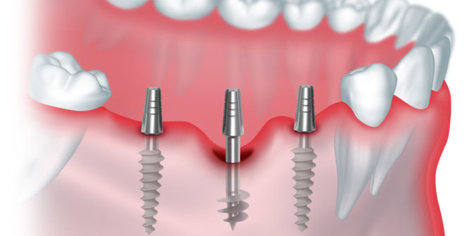 Implant dentaire basal