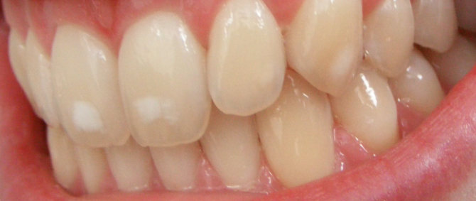 Taches blanches sur les dents