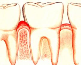 Gingivitis ng sakit sa gilagid