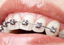 Damon 3 MX Braces