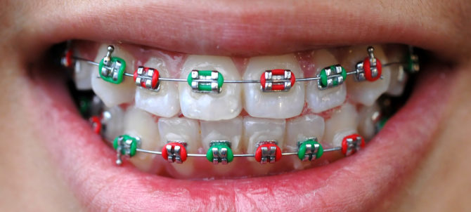 Braces para sa pag-align ng ngipin