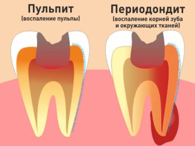 Ano ang pagkakaiba sa pagitan ng pulpitis at periodontitis