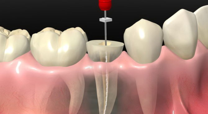 Enlèvement des dents