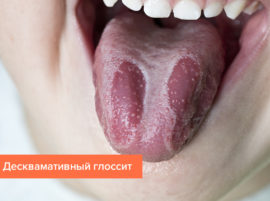 Desquamative glossitis