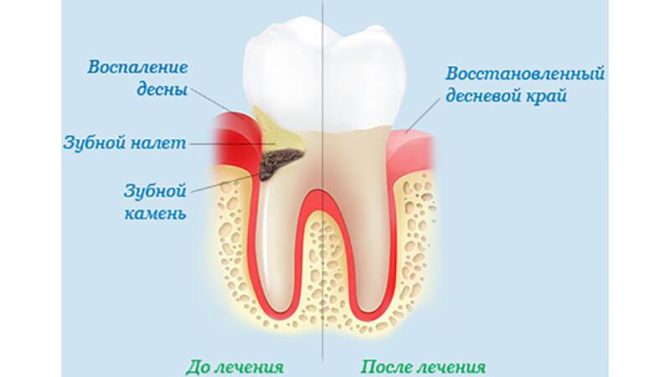 Gums bago at pagkatapos ng paggamot sa pamamaga