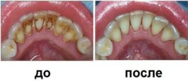 Avant et après l'enlèvement du tartre