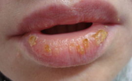 Exfoliative cheilitis