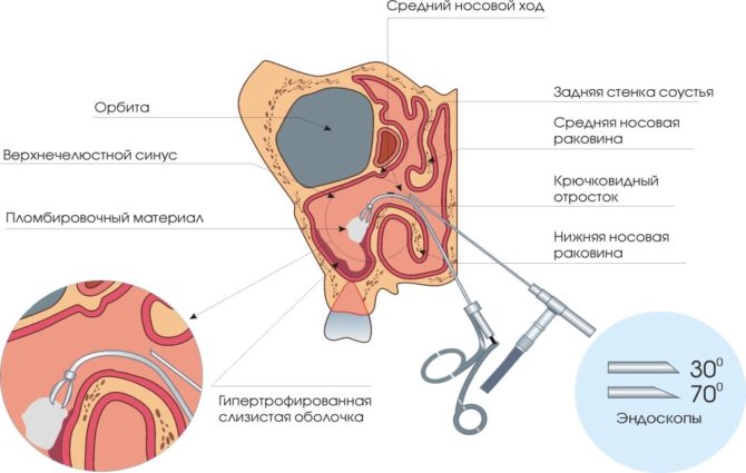 Méthode d'élimination des kystes endoscopiques