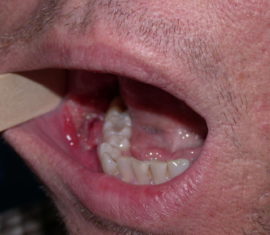 Erosive Leukoplakia