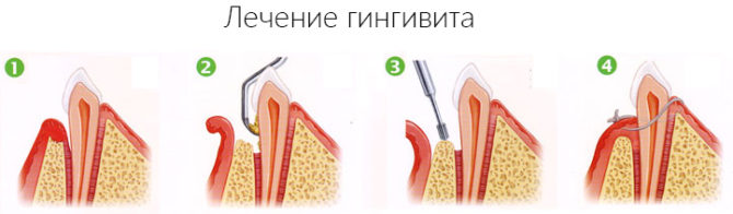 Étapes du traitement de la gingivite