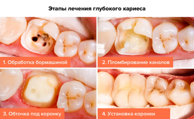 Étapes du traitement des caries