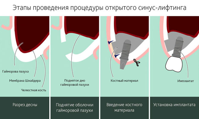 Étapes de la procédure de levage à sinus ouvert