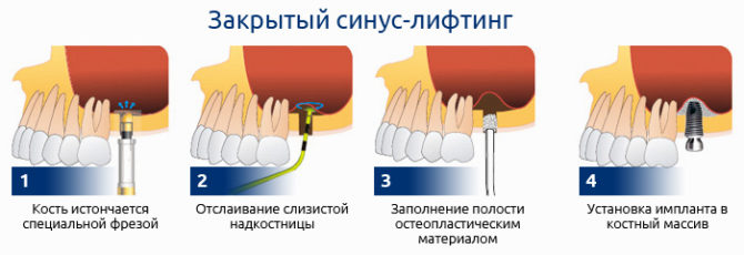 Mga yugto ng sarado na pamamaraan ng pag-angat ng sinus
