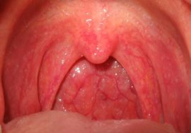 Pharyngitis