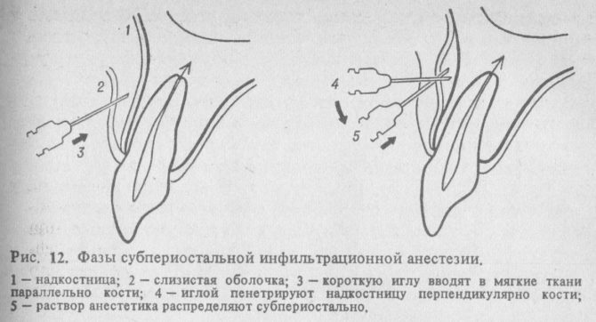 Phases of subperiosteal infiltration anesthesia