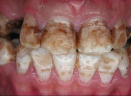 Ang fluorosis