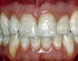 Ang fluorosis