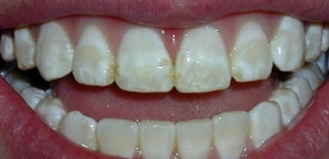 Ang fluorosis ng ngipin