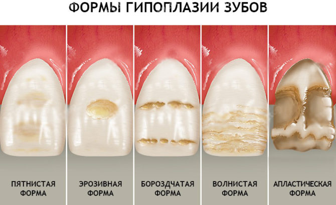 Mga Form ng Enamel Hypoplasia