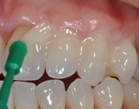 Fluoration de l'émail