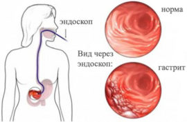 Gastritis