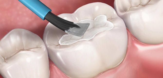 Fissure Sealing