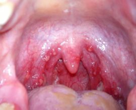 Mga herpes sa Tonsils