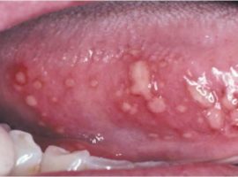 Herpetic glossitis