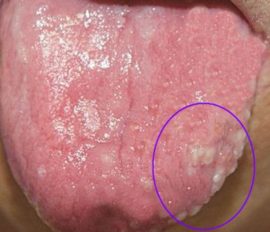 Herpetic glossitis