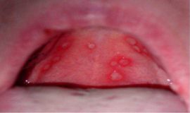 Herpetic stomatitis