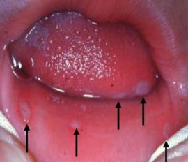 Herpetic stomatitis