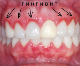 Gingivitis