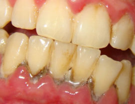 Gingivitis