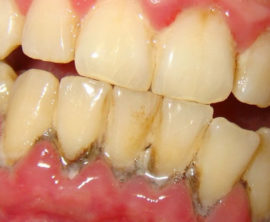 Gingivitis