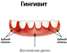 Gingivite sur les gencives