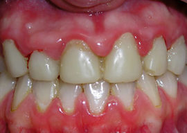 Hypertrophic gingivitis