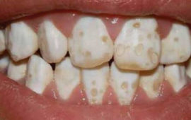 Enamel Hypoplasia