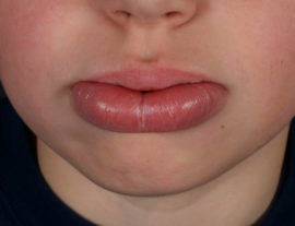 Hypovitaminous cheilitis