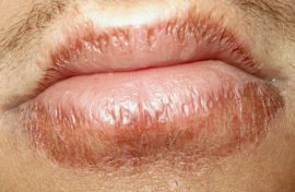 Glandular cheilitis