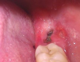 Purulent Alveolitis