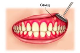 Purulentní fistula v dásni