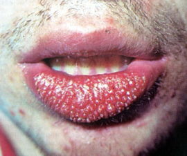 Granil cheilitis