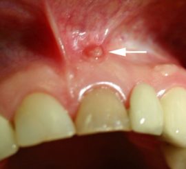 Granuloma sa gum