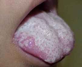 Fungal glossitis