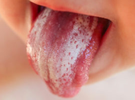 Fungal glossitis (thrush)